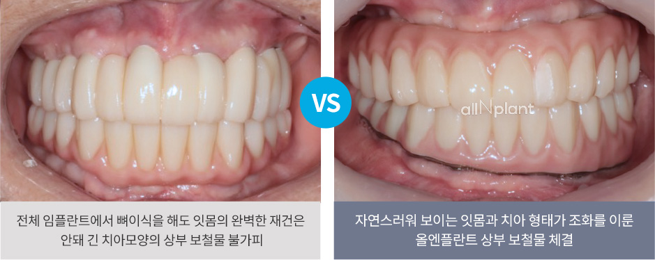 전체 임플란트에서 뼈이식을 해도 잇몸의 완벽한 재건은 안돼 긴 치아모양의 상부 보철물 불가피 VS 자연스러워 보이는 잇몸과 치아 형태가 조화를 이룬 올엔플란트 상부 보철물 체결