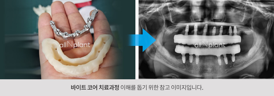 바이트 코어 치료과정 이해를 돕기위 한 참고 이미지입니다
