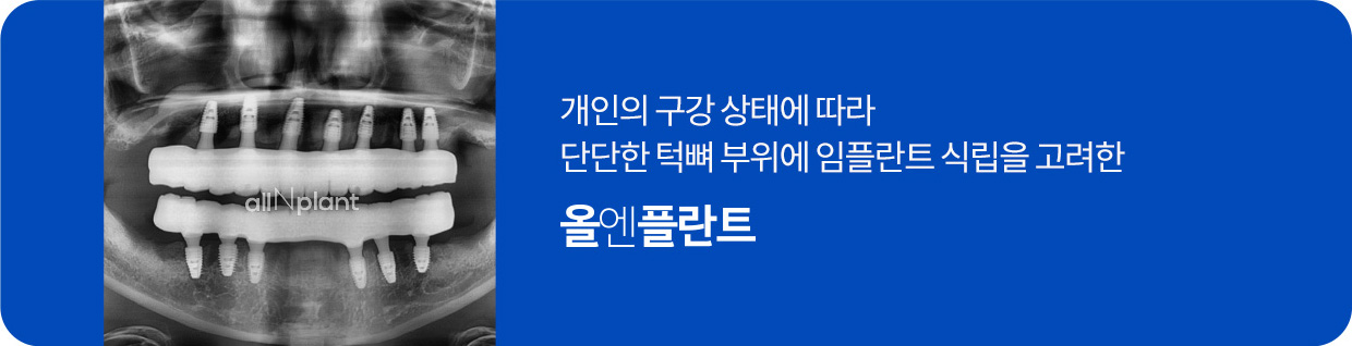 개인의 구강상태에 따라 단단한 턱뼈부위에 임플란트 식립을 고려한 올엔플란트