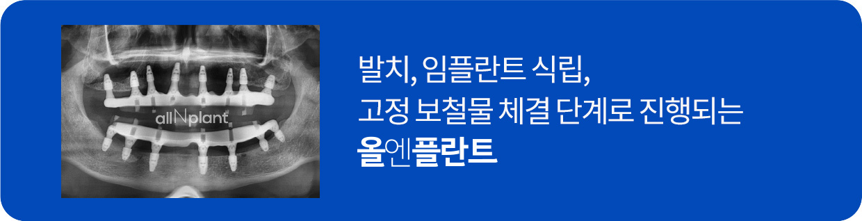 발치, 임플란트 식립, 고정 보철물 체결 단계로 진행되는 올엔플란트
