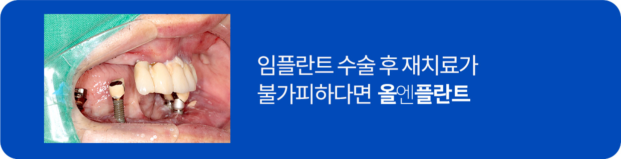 임플란트 수술 후 재치료가 불가피하다면 올엔플란트